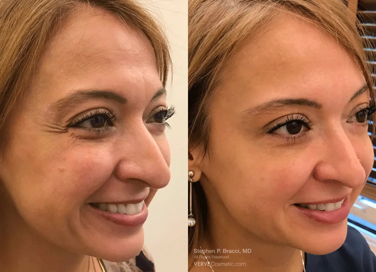 Crow's Feet (Botox) Before & After Gallery - Patient 595234 - Image 2