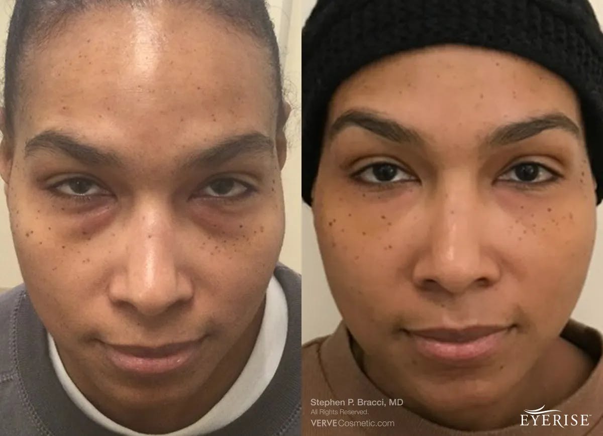 Eyerise™ Before & After Gallery - Patient 476700 - Image 1