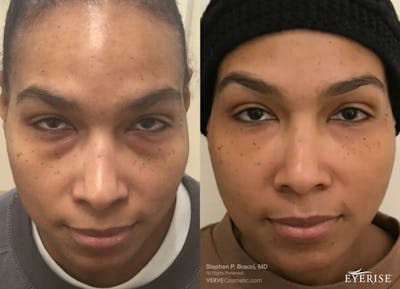 Eyerise™ Before & After Gallery - Patient 476700 - Image 1