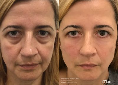 Eyerise™ Before & After Gallery - Patient 305749 - Image 1