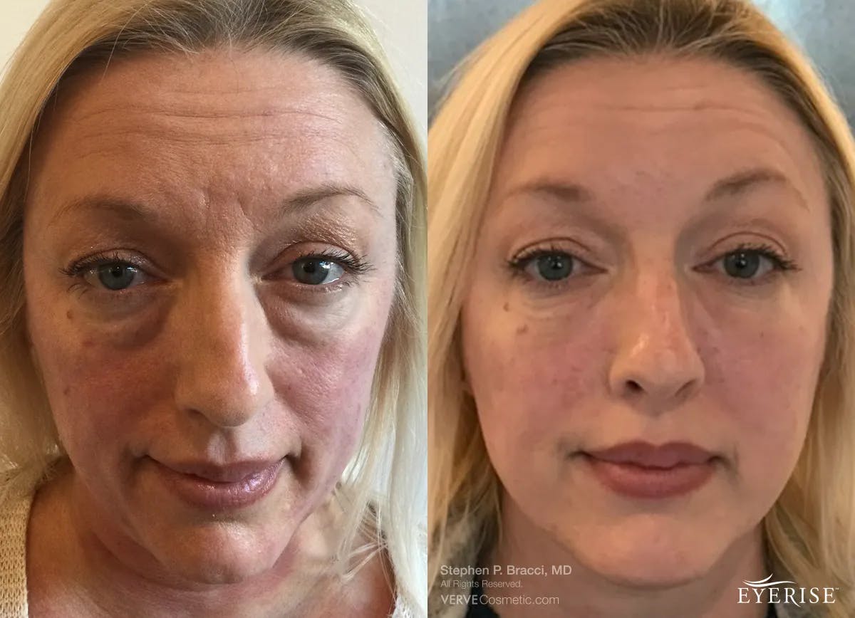 Eyerise™ Before & After Gallery - Patient 245887 - Image 1