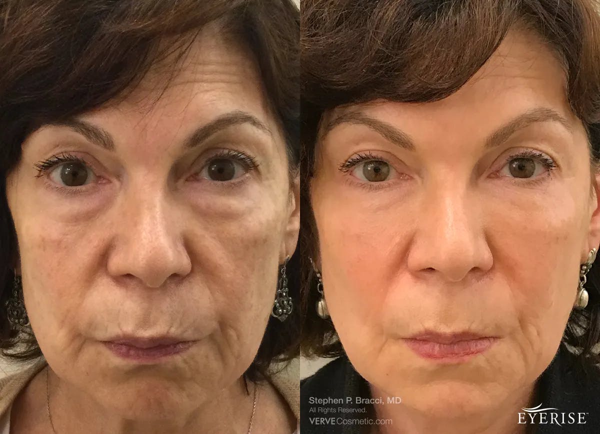 Eyerise™ Before & After Gallery - Patient 159249 - Image 1