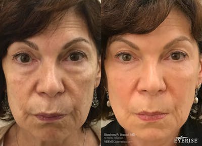 Eyerise™ Before & After Gallery - Patient 159249 - Image 1