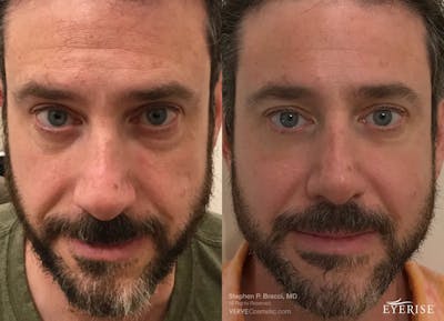 Eyerise™ Before & After Gallery - Patient 249070 - Image 1