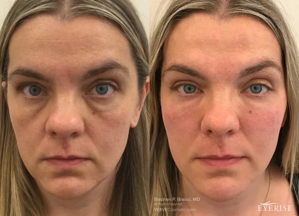 Eyerise™ Before & After Gallery - Patient 490856 - Image 1