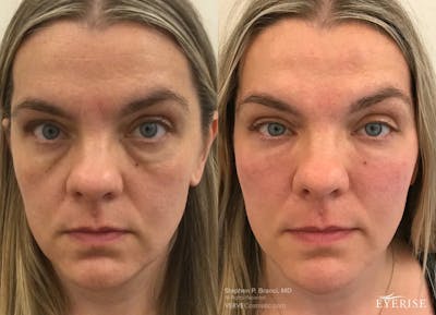 Eyerise™ Before & After Gallery - Patient 490856 - Image 1