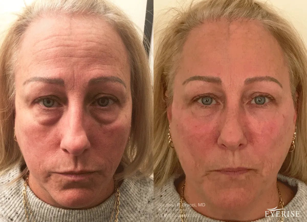 Eyerise™ Before & After Gallery - Patient 284316 - Image 1