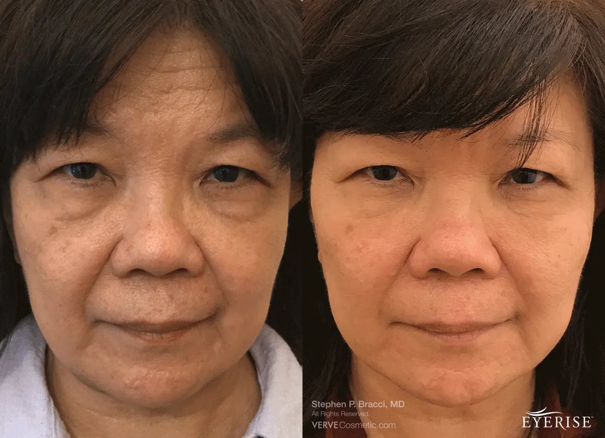 Eyerise™ Before & After Gallery - Patient 335475 - Image 1