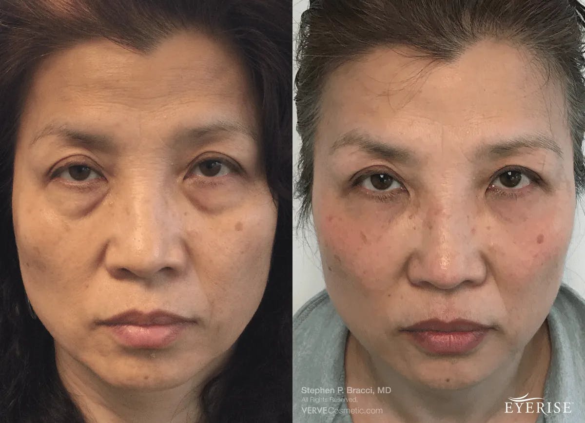 Eyerise™ Before & After Gallery - Patient 403527 - Image 1