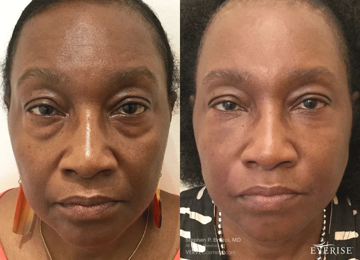 Eyerise™ Before & After Gallery - Patient 186783 - Image 1