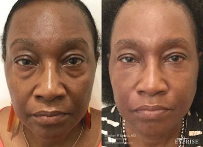 Eyerise™ Before & After Gallery - Patient 186783 - Image 1