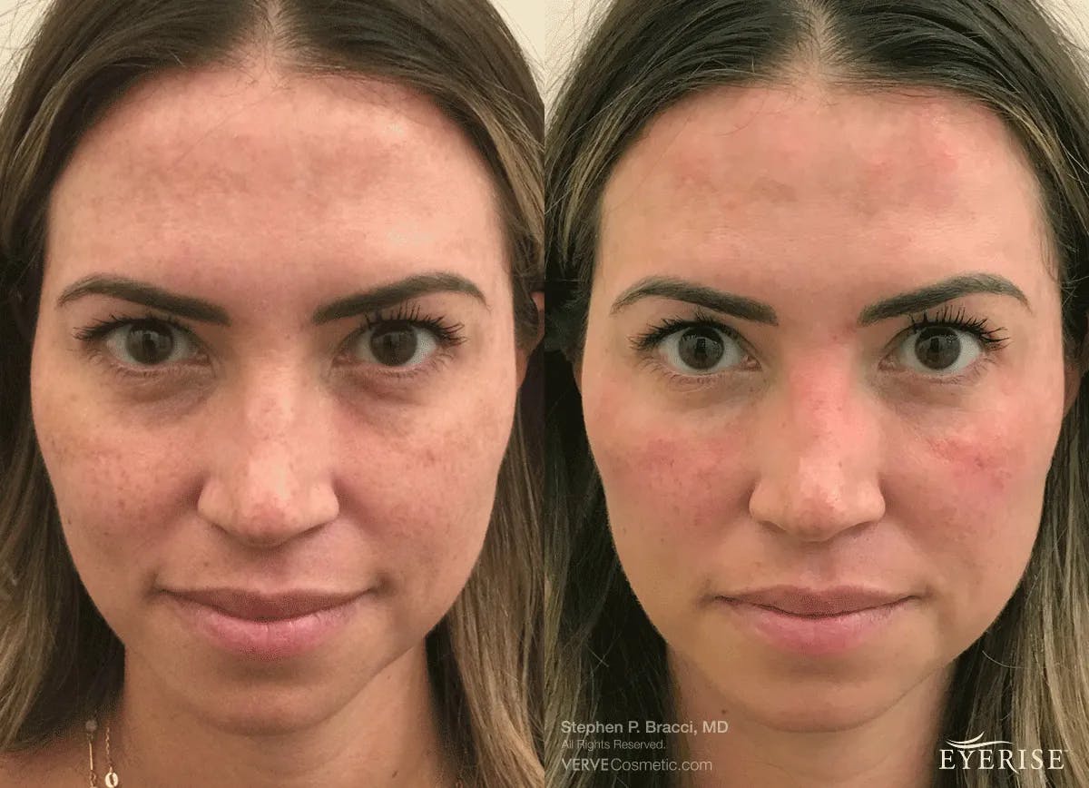 Eyerise™ Before & After Gallery - Patient 977623 - Image 1