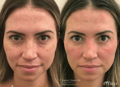 Eyerise™ Before & After Gallery - Patient 977623 - Image 1