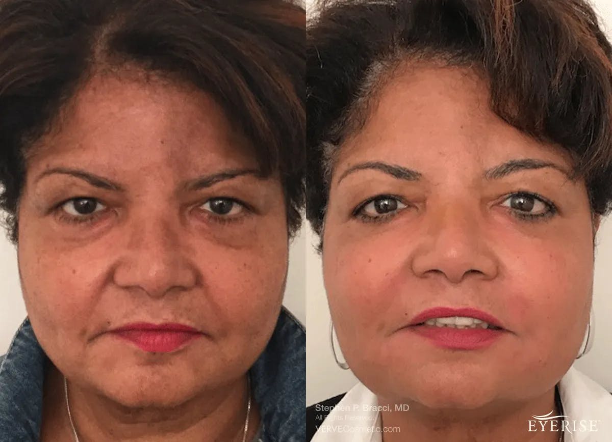 Eyerise™ Before & After Gallery - Patient 216051 - Image 1