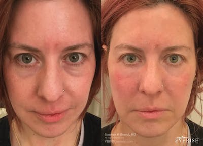 Eyerise™ Before & After Gallery - Patient 388559 - Image 1