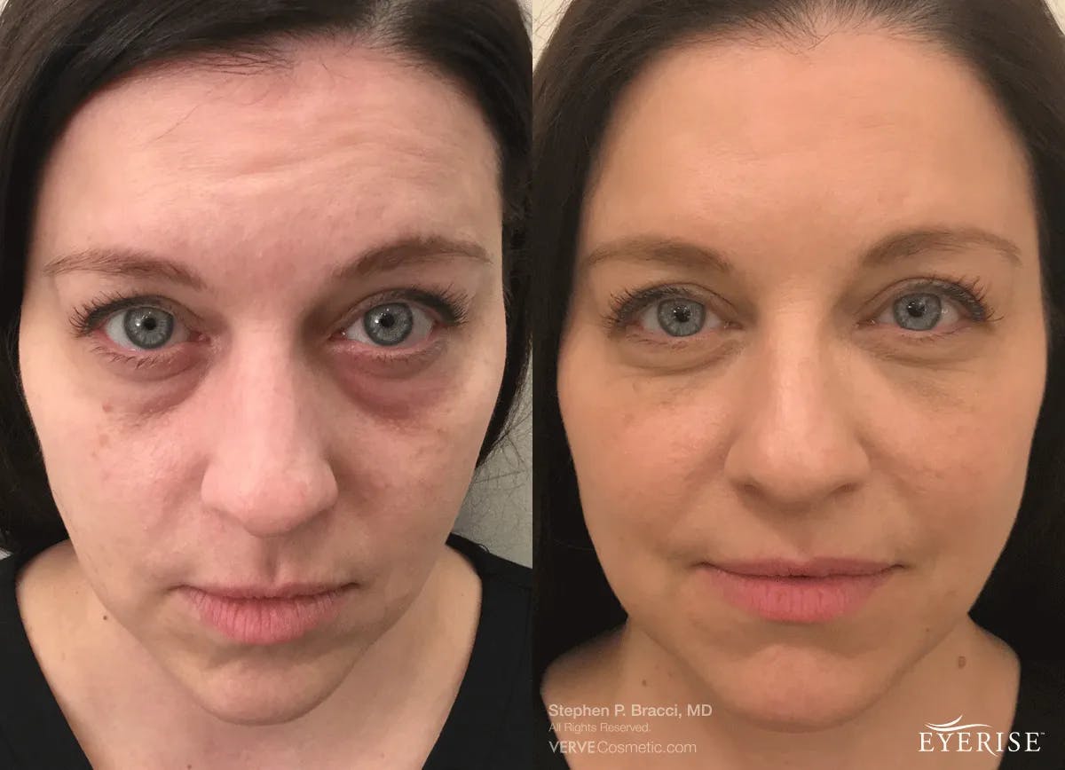 Eyerise™ Before & After Gallery - Patient 149762 - Image 1