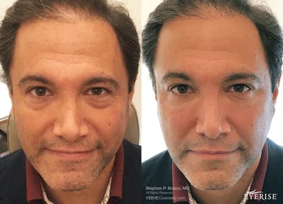 Eyerise™ Before & After Gallery - Patient 276795 - Image 1