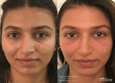 Eyerise™ Before & After Gallery - Patient 198153 - Image 1