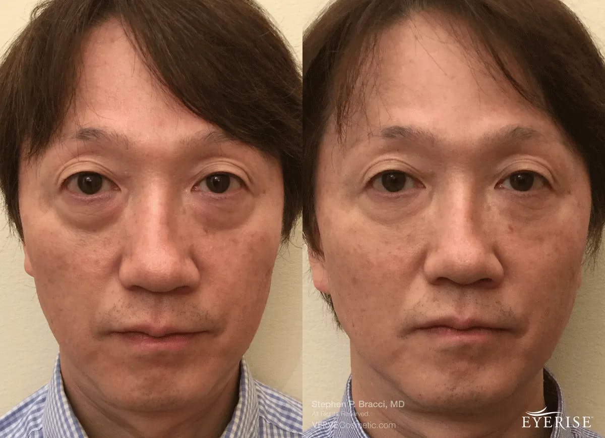 Eyerise™ Before & After Gallery - Patient 292430 - Image 1