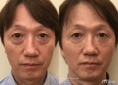 Eyerise™ Before & After Gallery - Patient 292430 - Image 1