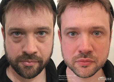 Eyerise™ Before & After Gallery - Patient 315379 - Image 1