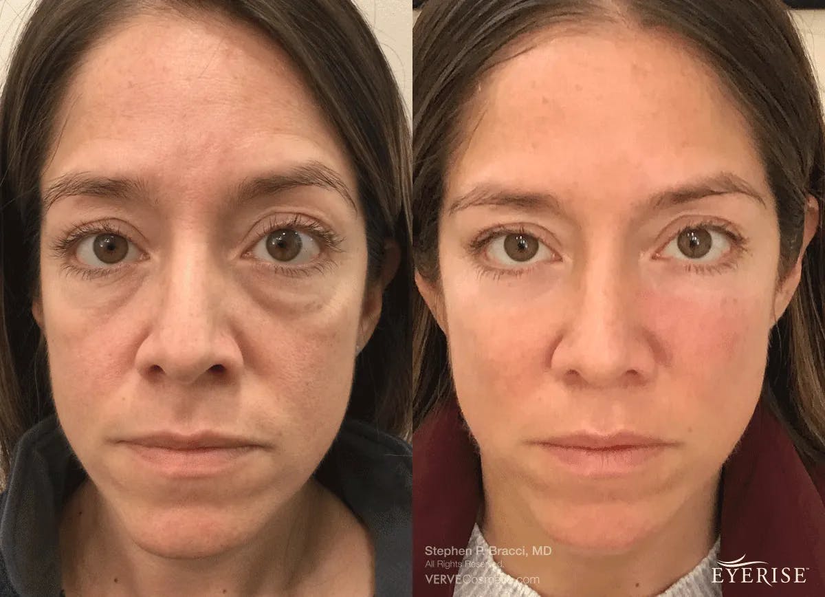 Eyerise™ Before & After Gallery - Patient 245214 - Image 1