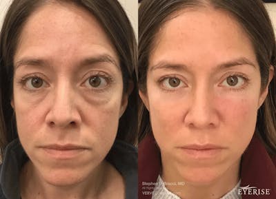 Eyerise™ Before & After Gallery - Patient 245214 - Image 1