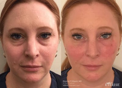 Eyerise™ Before & After Gallery - Patient 205110 - Image 1