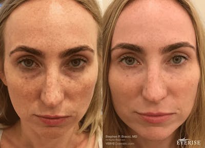 Eyerise™ Before & After Gallery - Patient 403365 - Image 1