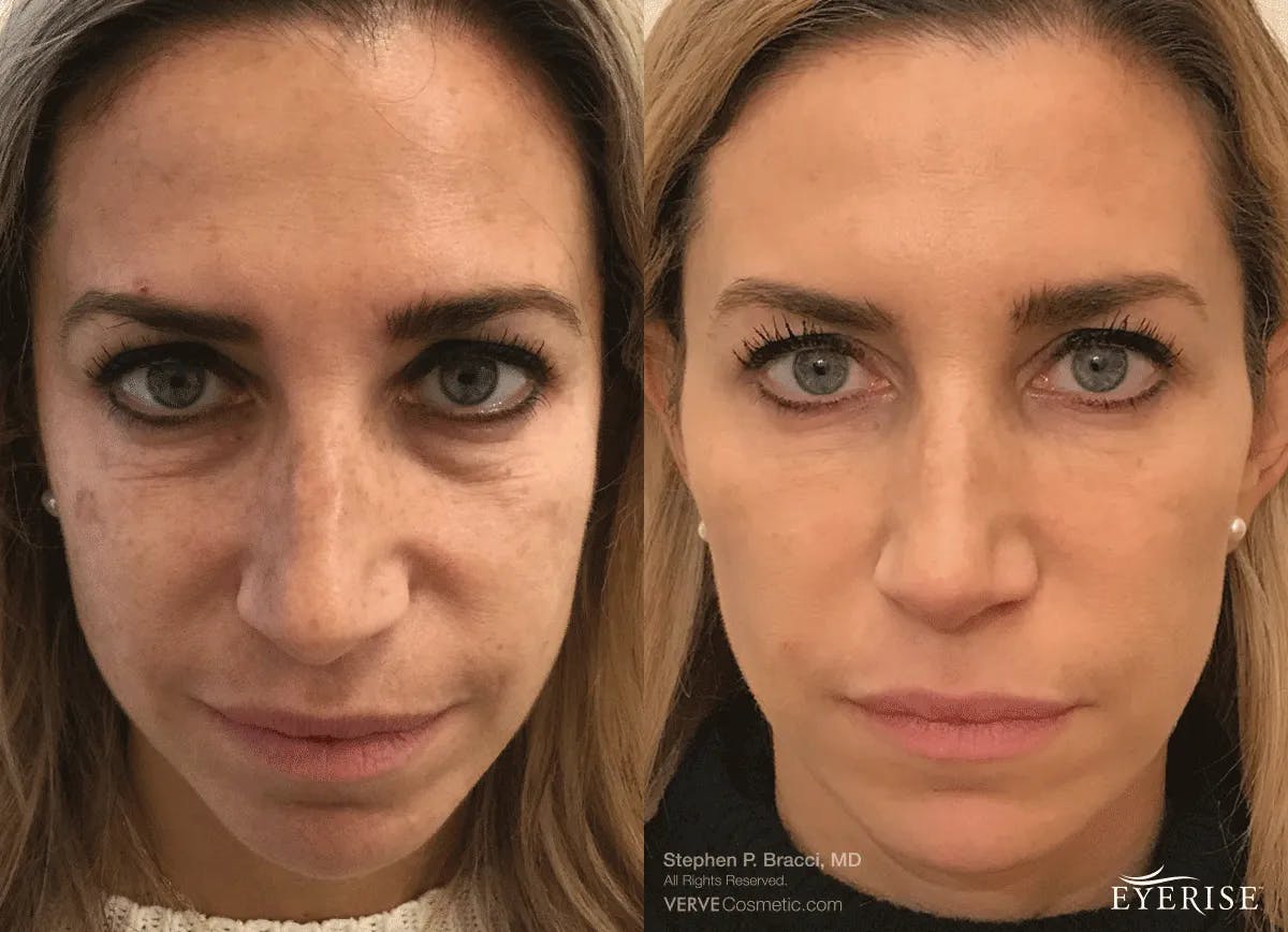 Eyerise™ Before & After Gallery - Patient 111433 - Image 1