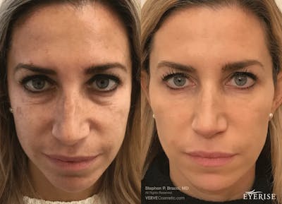 Eyerise™ Before & After Gallery - Patient 111433 - Image 1