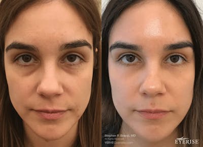 Eyerise™ Before & After Gallery - Patient 153458 - Image 1