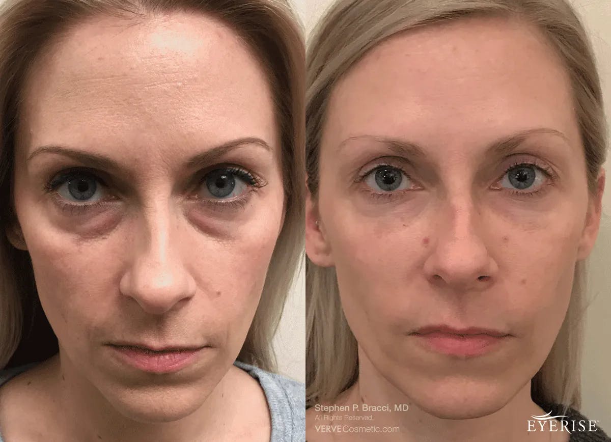 Eyerise™ Before & After Gallery - Patient 407207 - Image 1