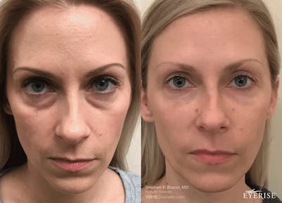 Eyerise™ Before & After Gallery - Patient 407207 - Image 1