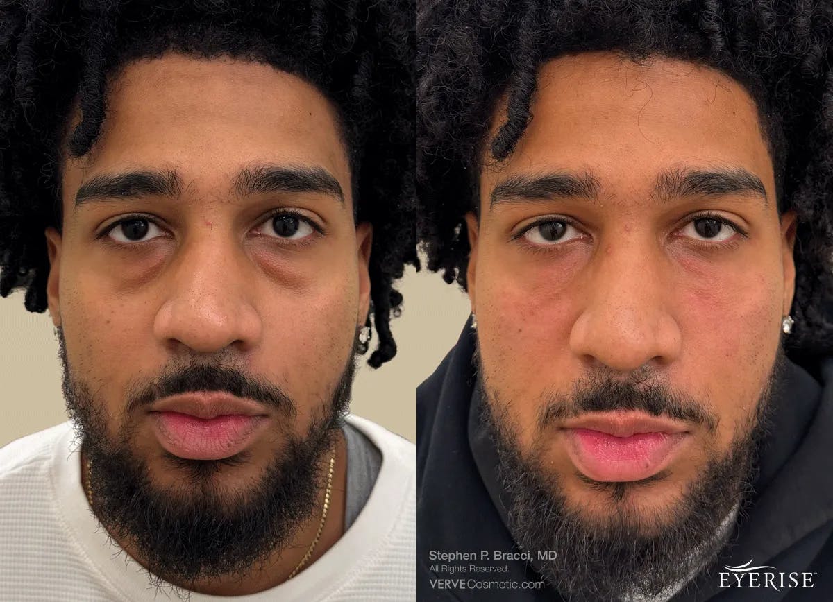 Eyerise™ Before & After Gallery - Patient 187884 - Image 1