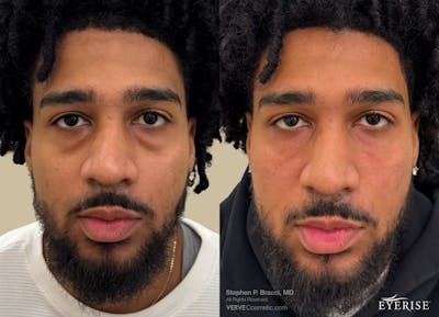 Eyerise™ Before & After Gallery - Patient 187884 - Image 1