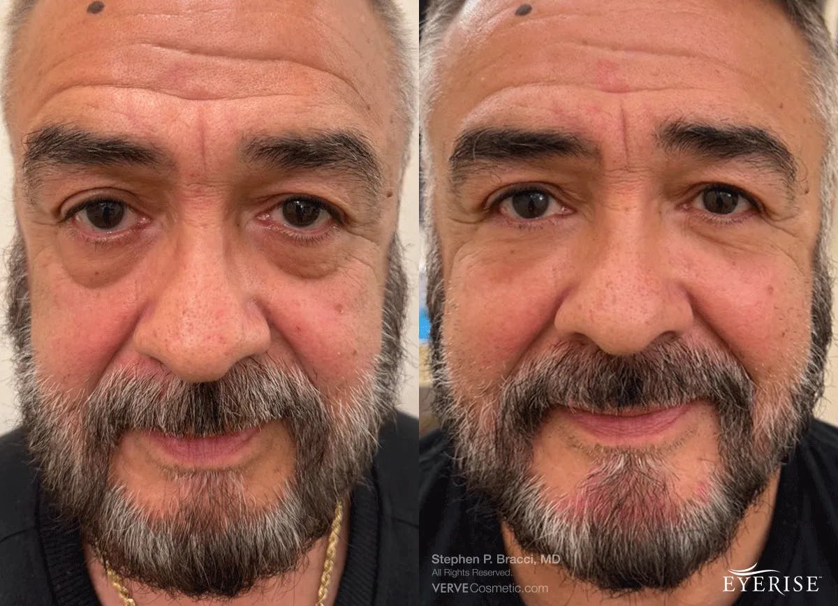 Eyerise™ Before & After Gallery - Patient 408168 - Image 1