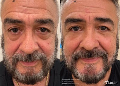 Eyerise™ Before & After Gallery - Patient 408168 - Image 1