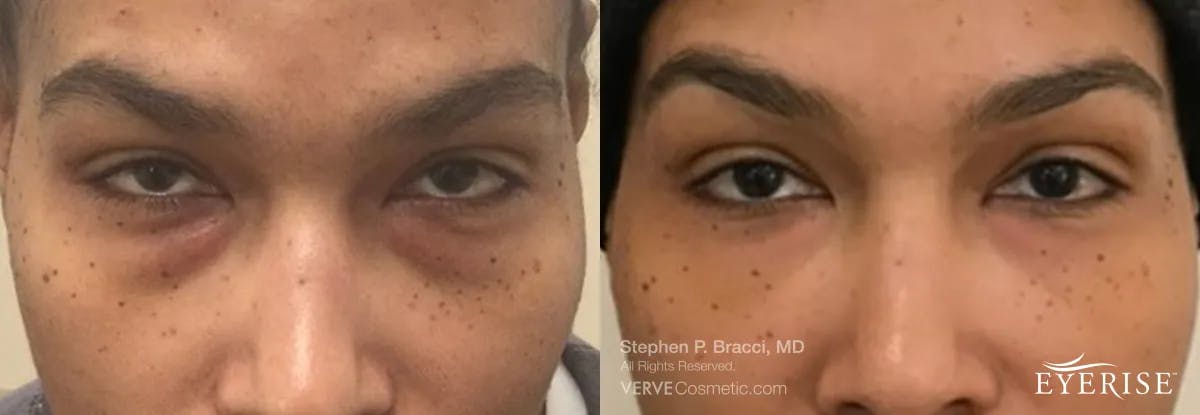 Eyerise™ Before & After Gallery - Patient 476700 - Image 2
