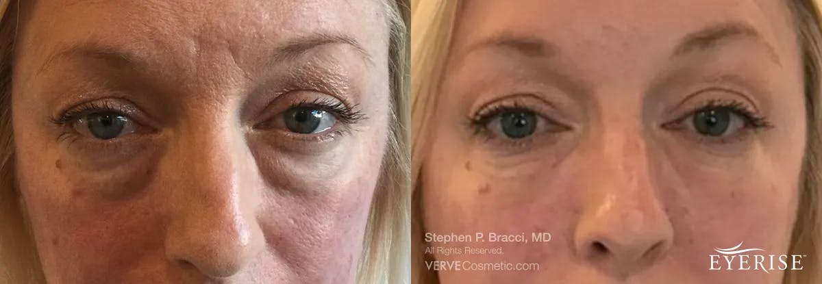 Eyerise™ Before & After Gallery - Patient 245887 - Image 2