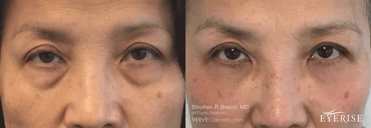 Eyerise™ Before & After Gallery - Patient 403527 - Image 2