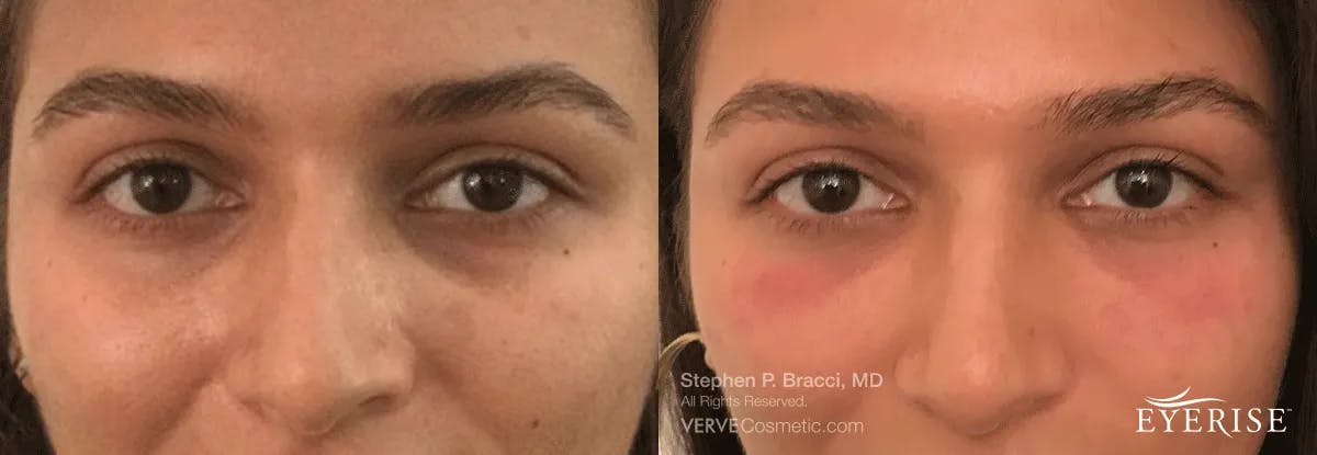 Eyerise™ Before & After Gallery - Patient 198153 - Image 2