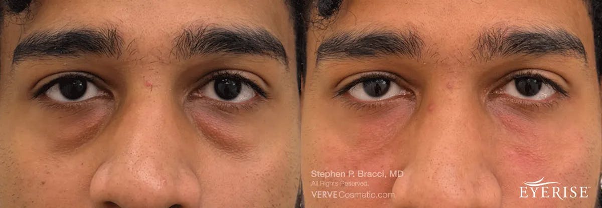 Eyerise™ Before & After Gallery - Patient 187884 - Image 2