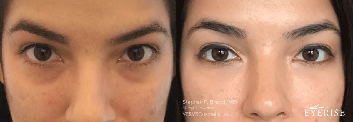 Eyerise™ Before & After Gallery - Patient 950242 - Image 2