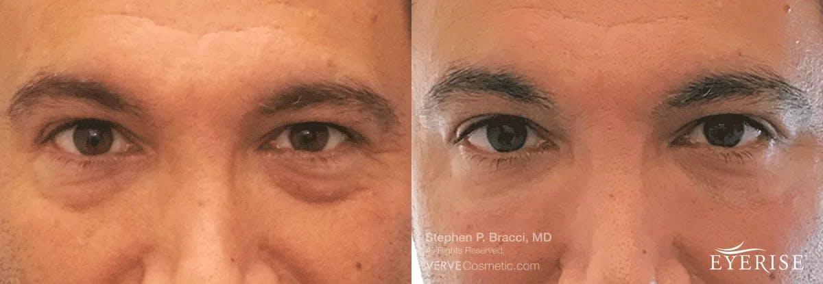 Eyerise™ Before & After Gallery - Patient 276795 - Image 2
