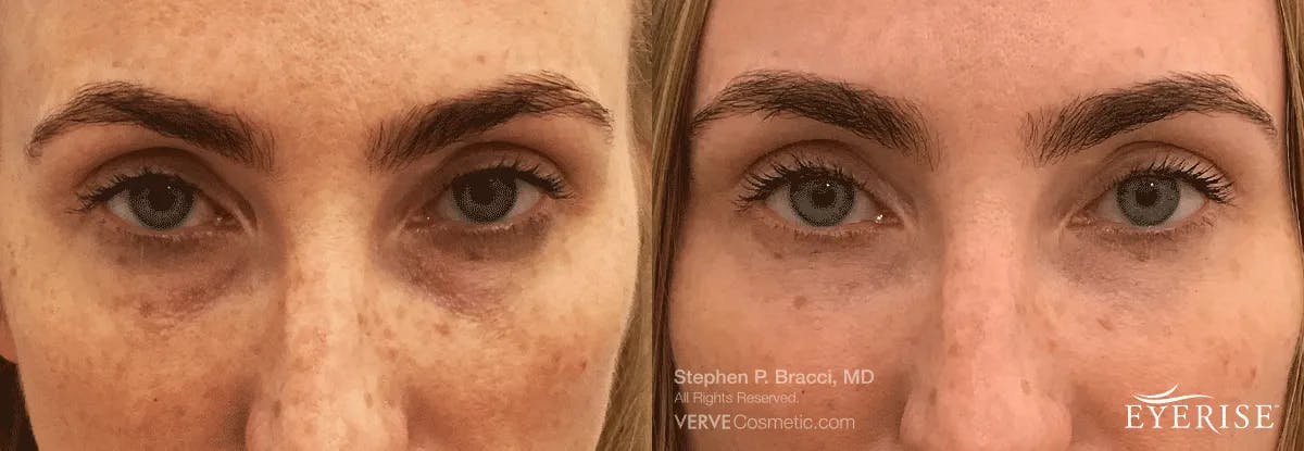 Eyerise™ Before & After Gallery - Patient 403365 - Image 2