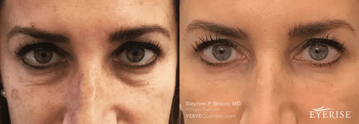 Eyerise™ Before & After Gallery - Patient 111433 - Image 2
