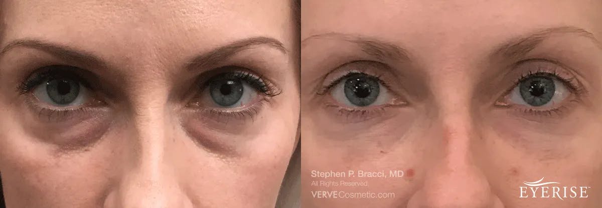 Eyerise™ Before & After Gallery - Patient 407207 - Image 2