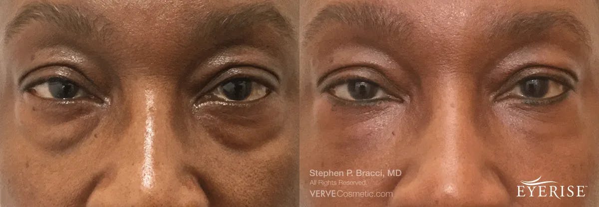 Eyerise™ Before & After Gallery - Patient 186783 - Image 2