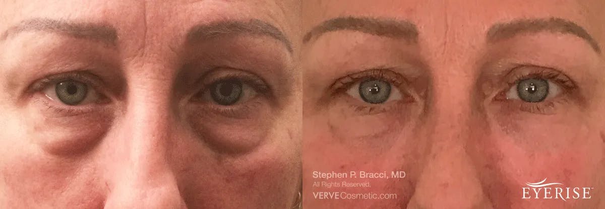 Eyerise™ Before & After Gallery - Patient 284316 - Image 2